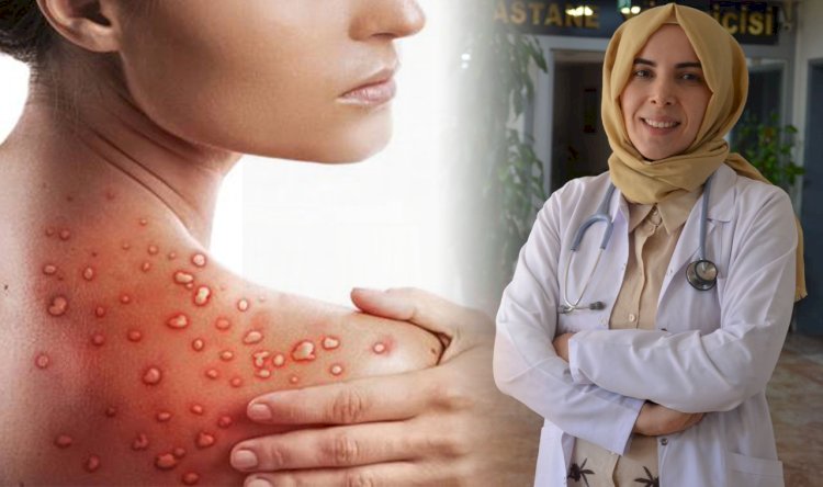 Urfa'da Görevli Uzman Uyardı! Maymun Çiçeği'nden Korunmanın Yolları
